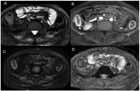 Imaging of Ulcerative Colitis: The Role of Diffusion-Weighted Magnetic ...