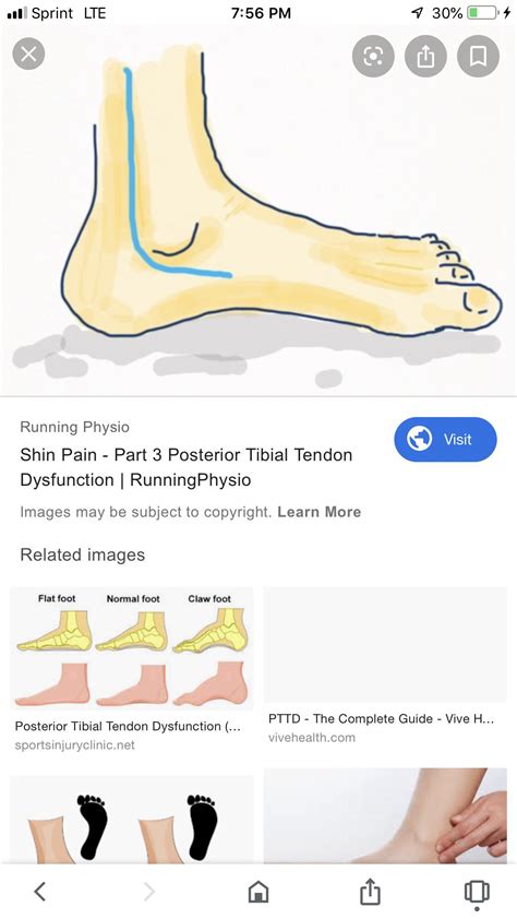 Sudden inner ankle pain when walking associated with plantar fasciitis ...