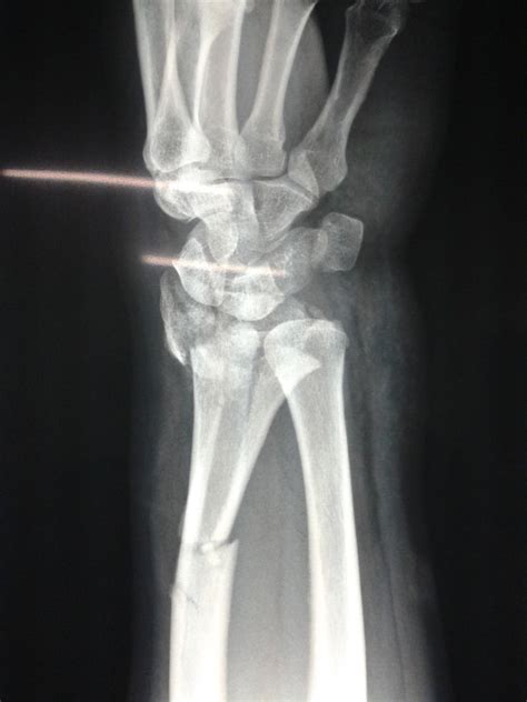Radius Fracture 的图像结果