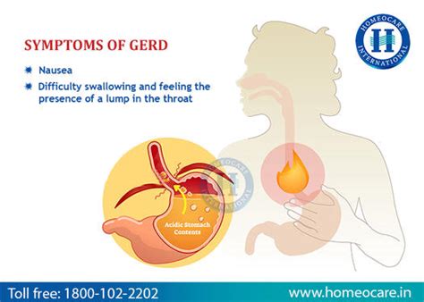 CONTROL GERD SUCCESSFULLY WITH HOMEOPATHY IN HUBLI - Health, Beauty ...