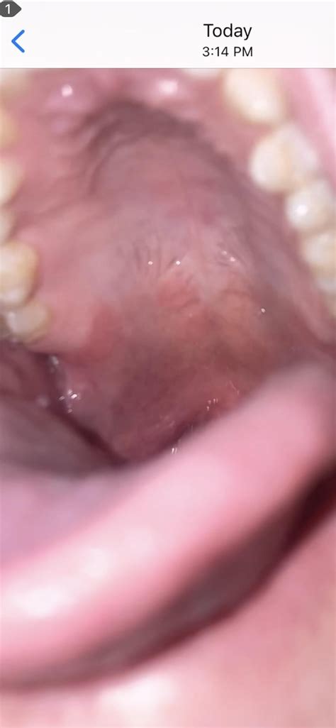 What do you think the bump on the roof of mouth is? : r/askdentists