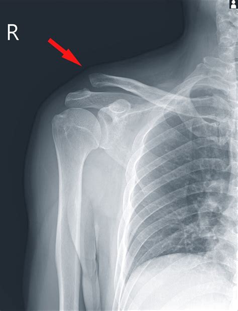 Ac Joint Fracture X Ray at Christopher Doyle blog