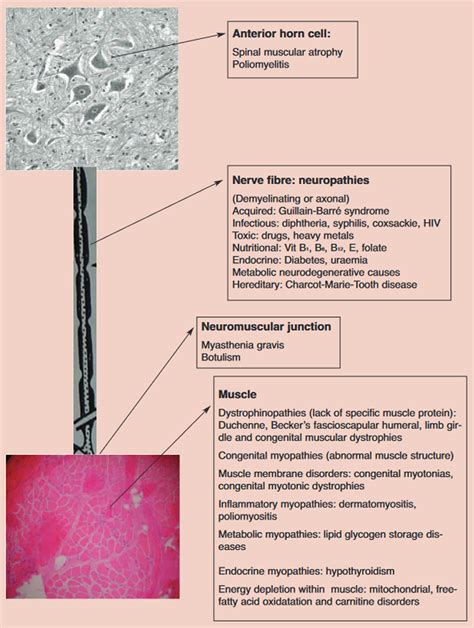 Floppy infant syndrome causes, symptoms, diagnosis, treatment & prognosis