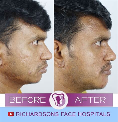 All You Need to Learn About Facial Scar Revision Surgery in India