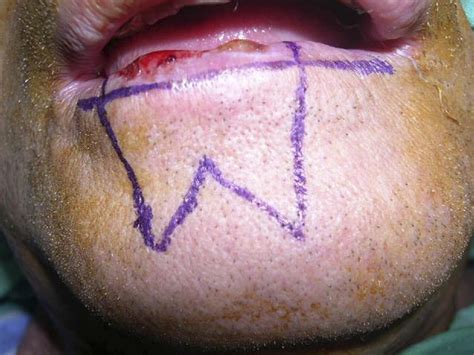 Smoking With Lip Laceration at Claire Dalrymple blog