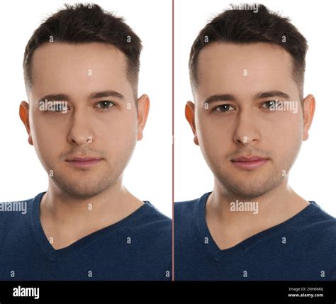 Collage with photos of man before and after lips augmentation Stock Photo - Alamy