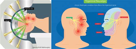 Trigeminal Neuralgia Trigger Points
