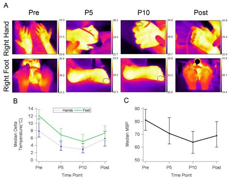 Quantifying and Trending the Thermal Signal as an Index of Perfusion in ...
