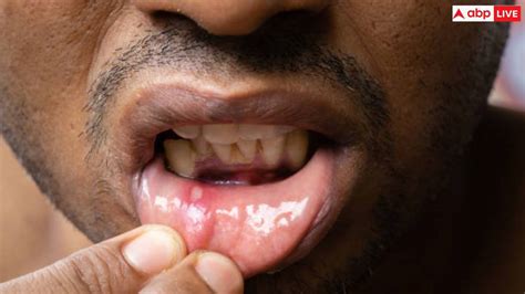 Mouth Ulcers: बार-बार मुंह में छाले हो जाते हैं? तो इन गंभीर बीमारियों ...