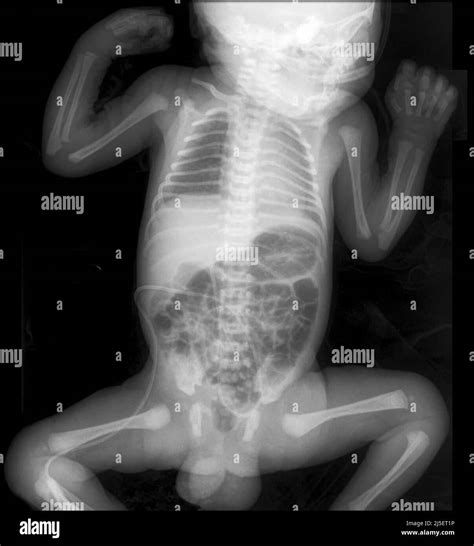 Baby x ray hi-res stock photography and images - Alamy