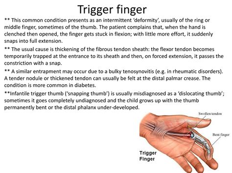 Trigger Finger Definition Etiology Symptoms Diagnosis
