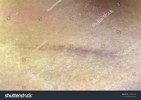 Appendix Surgery Scar: Over 320 Royalty-Free Licensable Stock Photos | Shutterstock