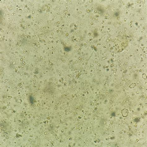 Amorphous Urates: Identification & Clinical Significance