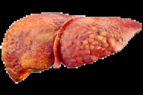 New drug could be first to stop deadly fatty liver disease: Study