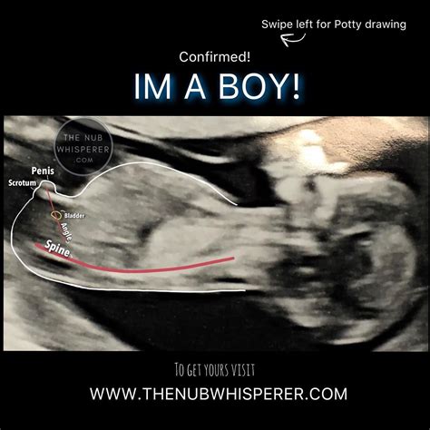 12 Week Ultrasound Boy