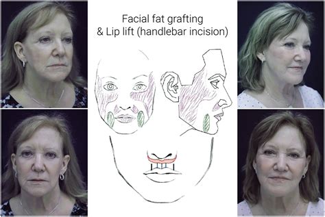 Face lifts, Brow lifts, Fat Transfers, Lip Lifts | Ricardo L. Rodriguez MD, Baltimore Plastic ...