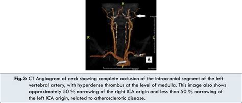 Dysphagia: Solitary Symptom of a Patient with Wallenberg’s Syndrome; A ...