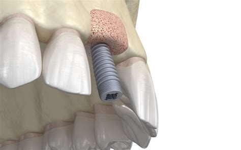 Tooth Implants Procedure 的图像结果