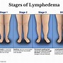 lymphedema 的图像结果