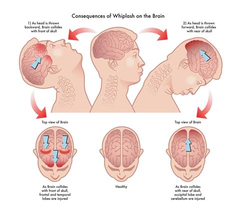 What To Expect After Whiplash: Common Sequelae & Management