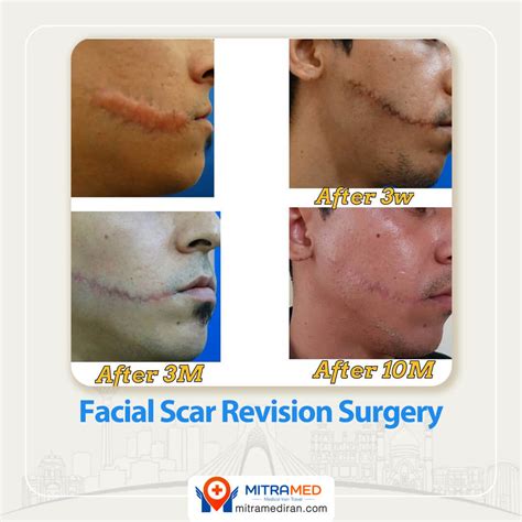 Scar Revision Procedure 的图像结果
