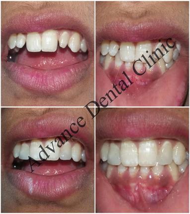 Best Dental in Outram Line - Advance Dental Clinic