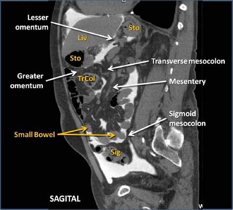 Peritoneum Anatomy Complete Peritoneal Reflections The Peritoneum
