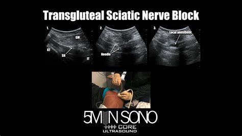 Sciatic Nerve Block