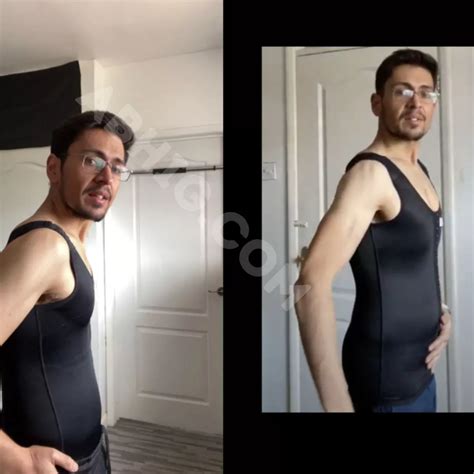 Gynaecomastia & Recovering From Abdominoplasty 4 Week News