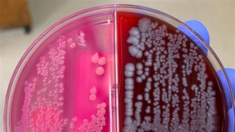 What Does It Mean When A Urine Culture Showed Mixed Flora
