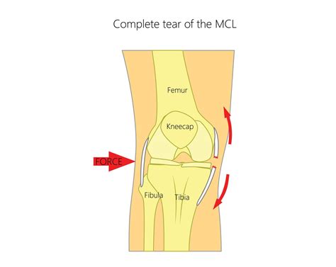 Medial Collateral Ligament (MCL) Tears | Upswing Health