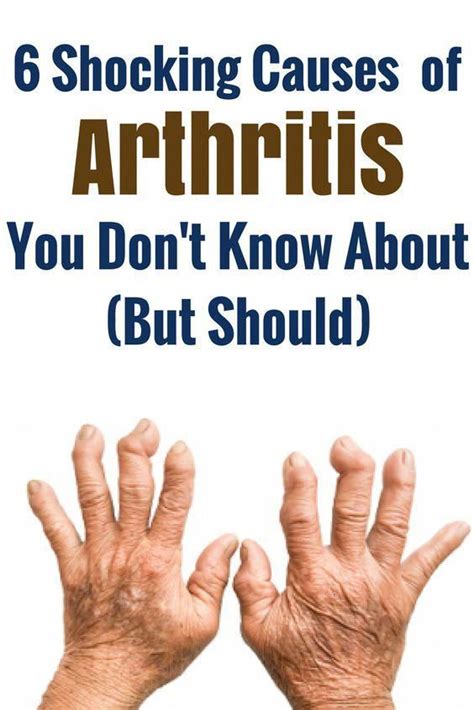 There are actually three common types of #arthritis. The treatments ...