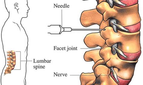 What are Spinal Injections’ Side Effects?