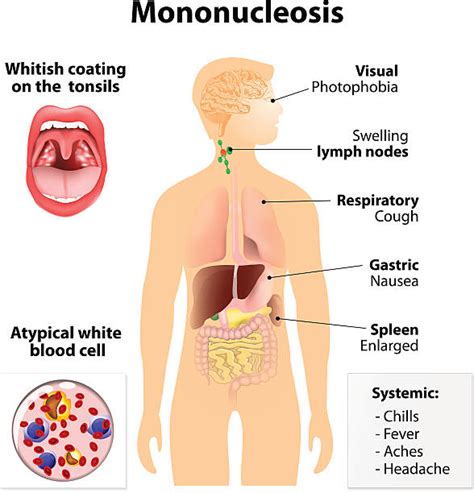 390+ Infectious Mononucleosis Stock Illustrations, Royalty-Free Vector ...