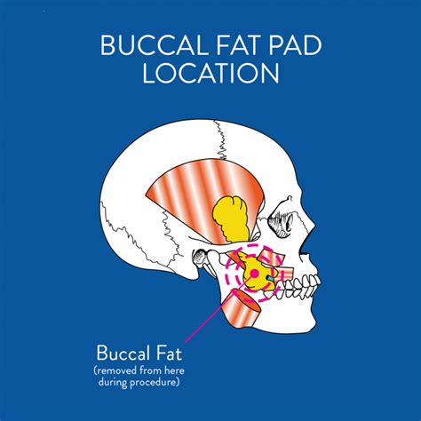 Buccal Fat Pad Reduction Procedure in Washington DC | Cheek Reduction
