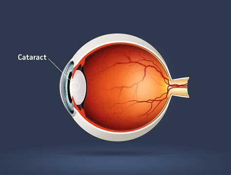 Cataract Eye Vision