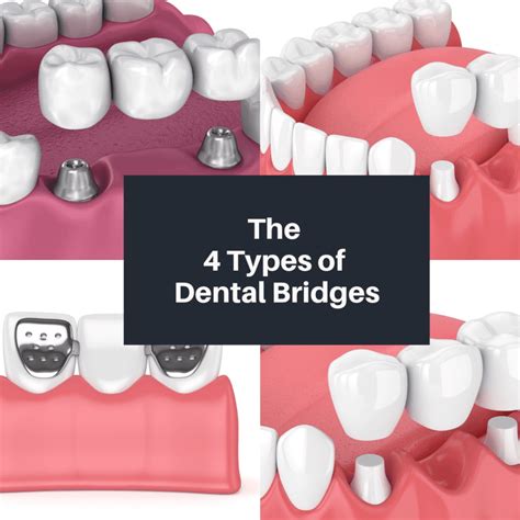 4 Types of Dental Bridges - Pasha Dental