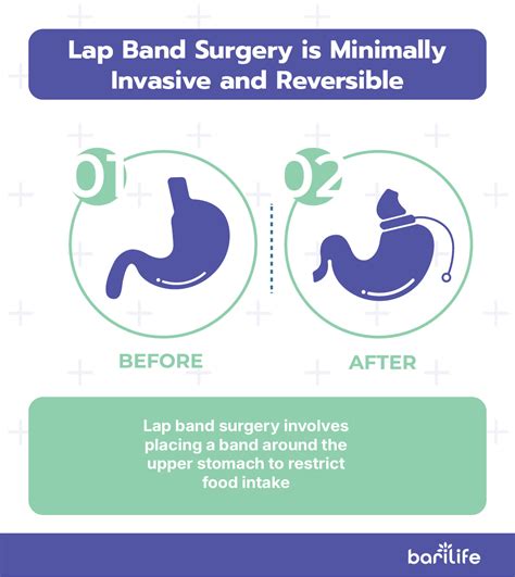 Lap Band Bariatric Surgery: 7 Essential Facts You Need to Know