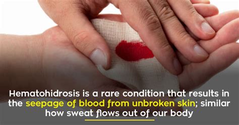 A Rare Condition That Causes People To Sweat 'Blood' Leave Doctors Baffled!