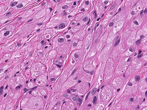 Granular Cell Tumours