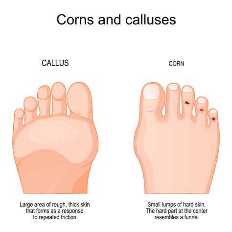 Large Painful Callus On Ball Of Foot Factory Sale | emergencydentistry.com