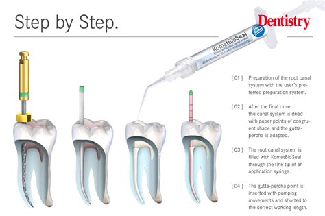 KometBioSeal – the new bioceramic root filling sealer - Dentistry
