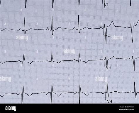 ECG ElectroCardioGraph paper that shows inferolateral T wave changes ...