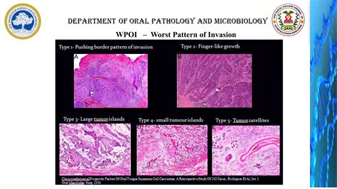 Staging & Grading of oral cancer | PPTX
