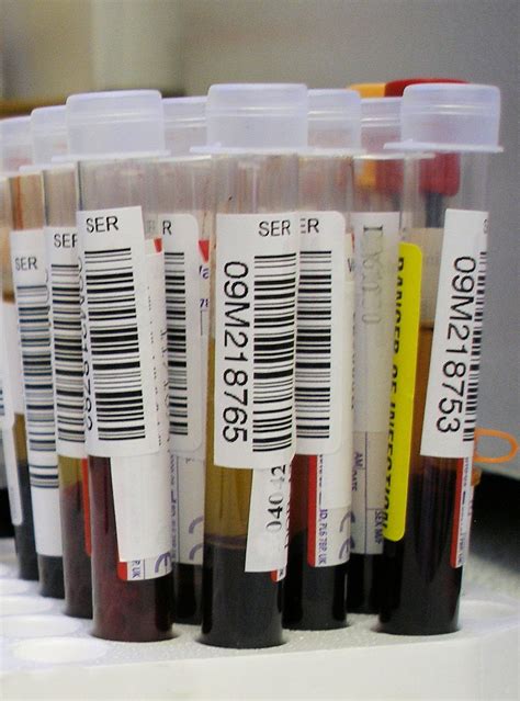 Antibody May Be Detectable in Blood Years Before MS Symptoms Appear - Neuroscience News