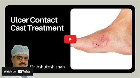 Charcot Foot Disease Treatment | Symptoms, Diagnosis & Prevention