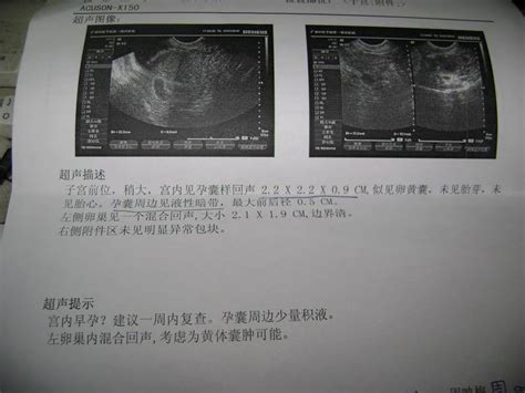 刚怀孕双胞胎报告单_单卵双胞胎b超图_微信公众号文章