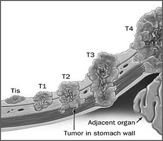 Metastatic Gastric Cancer | HER2 Positive Metastatic Breast Cancer ...