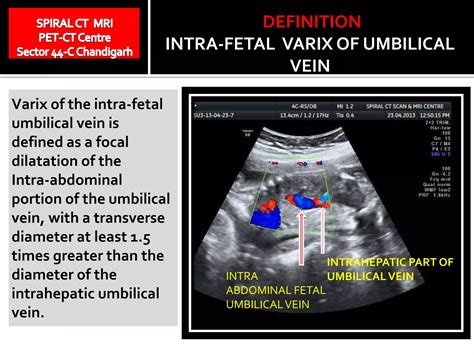 Dilated intra abdominal fetal umbilical vein | PPTX