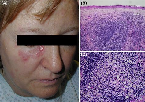 Face Rash Lymphoma at John Triche blog